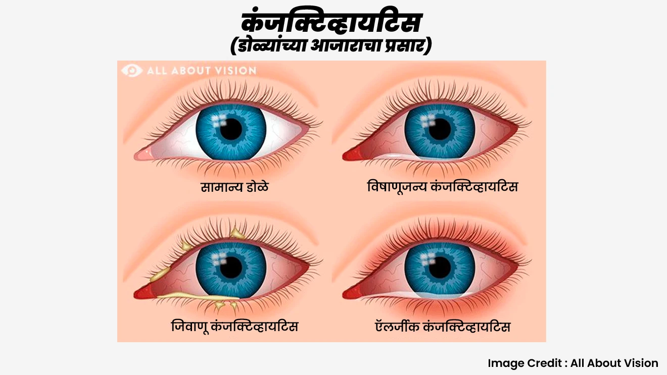 देशभरात कंजक्टिव्हायटिस या डोळ्यांच्या आजाराचा प्रसार