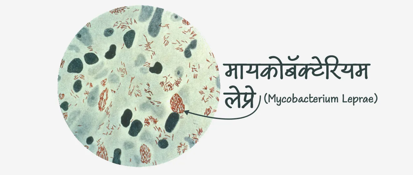 कुष्ठरोग कशामुळे होतो ?
• कुष्ठरोग हा एक संसर्गजन्य रोग आहे.
• कुष्ठरोग हा मायकोबॅक्टेरियम लेप्रे या जिवाणूमुळे होतो.
• नाक आणि तोंडातून थेंबांद्वारे जिवाणू प्रसारित केले जातात.
• हस्तांदोलन करणे किंवा कुष्ठरोग झालेल्या व्यक्तीला मिठी मारणे, एकत्र जेवण करणे किंवा एकमेकांच्या शेजारी बसणे यासारख्या अनौपचारिक संपर्कातून हा रोग पसरत नाही.