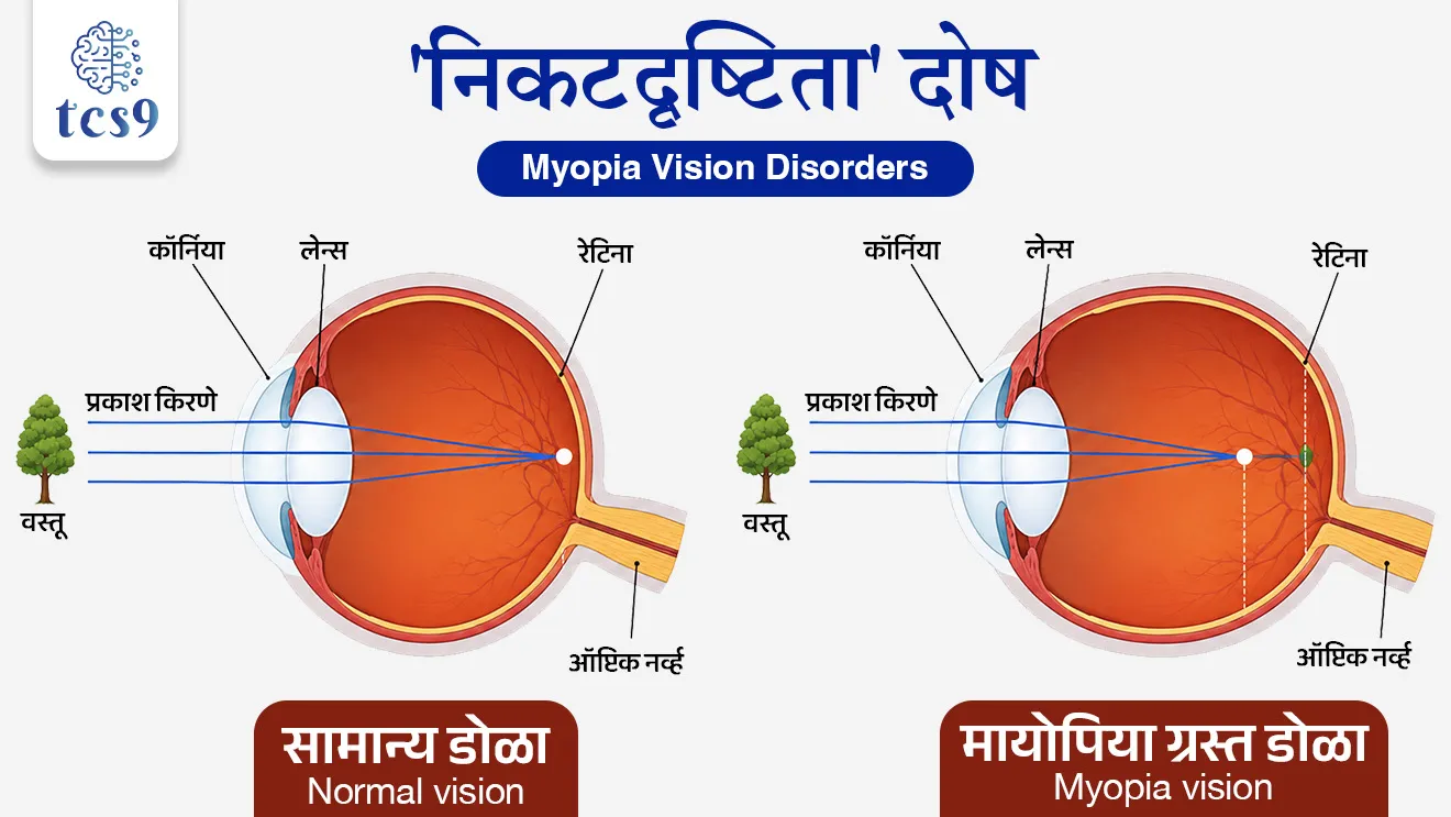 Myopia Pandemic

📚 Subject : GS - विज्ञान आणि तंत्रज्ञान - भौतिकशास्त्र, जीवशास्त्र
सरळसेवा, तलाठी, वनरक्षक, पोलीस भरती, अग्निवीर , रेल्वे भरती, SSC GD, MPSC, UPSC परीक्षेसाठी विचारलेले / संभाव्य महत्त्वपूर्ण  प्रश्न

प्रश्न)डोळ्यांच्या 'निकटदृष्टिता' (Myopia) या दोषाचे निवारण करण्यासाठी खालीलपैकी कोणत्या प्रकारच्या भिंगाचा (Lens) वापर केला जातो ?
 बहिर्गोल भिंग (Convex Lens)
अंतर्गोल भिंग (Concave Lens)
 द्विनाभीय भिंग (Bifocal Lens)
समतल भिंग (Plain Lens)

उत्तर : अंतर्गोल भिंग (Concave Lens)


📰 बातमी काय ?
वर्ष 2050 पर्यंत जगातील सुमारे 4.75 billion (४.७५ अब्ज) लोक, म्हणजेच जगाच्या एकूण लोकसंख्येच्या जवळपास निम्मी लोकसंख्या 'मायोपिया'ने (निकटदृष्टिता) ग्रस्त असण्याचा अंदाज वर्तवण्यात आला आहे.

🇮🇳 भारतातील वाढती चिंता - 
भारतातील शहरी मुलांमध्ये मायोपियाचे प्रमाण 1999 मध्ये केवळ 4.44% होते, जे 2019 मध्ये वाढून 21.15% झाले आहे.
जागतिक आरोग्य संघटनेच्या अंदाजानुसार 2050 पर्यंत भारतातील जवळपास 48% शहरी मुले ‘निकटदृष्टिता’ या दोषाने प्रभावित होतील.

👁️ मायोपिया म्हणजे काय ? (What is Myopia ?)
'मायोपिया' याला मराठीत 'निकटदृष्टिता' किंवा 'लघुदृष्टी दोष' असे म्हणतात.
हा डोळ्यांचा एक असा दोष आहे, ज्यामध्ये व्यक्तीला जवळच्या वस्तू स्पष्ट दिसतात, परंतु दूरच्या वस्तू अंधुक किंवा अस्पष्ट दिसतात.

🧐 तांत्रिक कारण (Scientific Cause) :
हा दोष डोळ्याचा अक्षीय गोलक जास्त लांब झाल्यामुळे (Excessive axial elongation of the eye) निर्माण होतो.
निरोगी डोळ्यामध्ये प्रकाशाची किरणे थेट दृष्टिपटलावर (Retina) एकत्र येतात. 
परंतु, मायोपिया झालेल्या डोळ्यामध्ये अक्षीय लांबी (डोळ्याचा पुढचा व मागचा भाग यांमधील अंतर) जास्त वाढल्यामुळे दूरवरून येणारे प्रकाश किरण दृष्टिपटलाच्या (Retina) थेट वर पडण्याऐवजी त्याच्या अलीकडेच (In front of the retina) केंद्रित होतात, यामुळे दूरचे दृश्य अंधुक दिसते.

✍️ भौतिकशास्त्र संदर्भ (Physics concept) - 
अंतर्गोल भिंग (Concave Lens) -  मायोपिया किंवा निकटदृष्टिता हा दोष दूर करण्यासाठी चष्म्यात किंवा कॉन्टॅक्ट लेन्समध्ये अंतर्गोल भिंगाचा (Concave Lenses) वापर केला जातो.
कार्यपद्धती - अंतर्गोल भिंग हे अपसारी (Diverging) भिंग असते. ते दूरवरून येणाऱ्या प्रकाश किरणांना थोडे पसरवते, ज्यामुळे प्रकाशाचा फोकस योग्य ठिकाणी म्हणजेच परत थेट दृष्टिपटलावर (Retina) पडतो आणि दृष्टी पूर्ववत स्पष्ट होते.

🧐 'निकटदृष्टिता' दोषामुळे निर्माण होणाऱ्या समस्या आणि धोके (Health Concerns):
A) हाय मायोपिया (High Myopia) - जेव्हा डोळ्याचा अपवर्तन दोष -6 डायोप्टर (-6 dioptres) किंवा त्याहून अधिक वाढतो, तेव्हा त्याला 'हाय मायोपिया' म्हणतात.
यामुळे डोळ्यांची दृष्टी कायमची जाण्याचा किंवा अंधत्व (Blindness) येण्याचा गंभीर धोका असतो.

B) डोळ्यांच्या ऊतींचे नुकसान - डोळ्याचा अक्षीय गोलक जास्त लांब झाल्यामुळे डोळ्यातील महत्त्वाचे पडदे जसे की, दृढपटल (Sclera), रक्तपटल (Choroid) आणि दृष्टिपटल (Retina) ताणले जातात व पातळ होतात.
यामुळे खालील गंभीर आजारांचा धोका वाढतो.
1) Retinal Detachment : दृष्टिपटल आपल्या जागेवरून बाजूला होणे.
2) Glaucoma : काचबिंदू (डोळ्यातील अंतर्गत दाब वाढणे).
3) Early Cataract : वेळेपूर्वी किंवा लवकर मोतीबिंदू होणे.
4) Myopic Macular Degeneration : दृष्टीच्या मुख्य केंद्राचा ऱ्हास होणे.

⛳️ प्रतिबंधात्मक उपाय (Prevention) :
1) मैदानी खेळांना प्राधान्य (Outdoor Time): वैज्ञानिक संशोधनानुसार, मुलांनी घराबाहेर किंवा नैसर्गिक सूर्यप्रकाशात (Outdoor time) जास्त वेळ घालवल्यास मायोपिया वाढण्याचा धोका लक्षणीयरीत्या कमी होतो.
2) नियमित तपासणी : शालेय वयाच्या मुलांची डोळ्यांची नियमित तपासणी (Regular eye exams) करणे लवकर निदानासाठी अत्यंत आवश्यक आहे.


🔑 परीक्षेच्या दृष्टीने IMP रिव्हिजन पॉईंट्स :  'निकटदृष्टिता' (Myopia) 
 मायोपियाचे मराठी नाव → निकटदृष्टिता; जवळचे स्पष्ट दिसते, दूरचे अस्पष्ट दिसते.
निकटदृष्टिता → जवळचे स्पष्ट दिसते, दूरचे अस्पष्ट दिसते.
 प्रकाश किरण कुठे केंद्रित होतात → दृष्टीपटलाच्या (Retina) समोर.
 दोष निवारणासाठी वापरले जाणारे भिंग → अंतर्वक्र भिंग (Concave Lens).
 हाय मायोपियाची तांत्रिक व्याख्या → चष्म्याचा नंबर -6 डायोप्टर किंवा त्याहून अधिक असणे.
 भारतातील 2050 चा अंदाज → जवळपास 48% शहरी मुलांना मायोपिया होण्याचा धोका.








प्रश्न)डोळ्यांच्या 'निकटदृष्टिता' (Myopia) या दोषाचे निवारण करण्यासाठी खालीलपैकी कोणत्या प्रकारच्या भिंगाचा (Lens) वापर केला जातो ?
 बहिर्गोल भिंग (Convex Lens)
अंतर्गोल भिंग (Concave Lens)
 द्विनाभीय भिंग (Bifocal Lens)
समतल भिंग (Plain Lens)

उत्तर : अंतर्गोल भिंग (Concave Lens)



प्रश्न) वाढत्या मायोपिया (Myopia) संकटाच्या संदर्भात खालील विधाने विचारात घ्या : 
अ) मायोपिया हा डोळ्यांचा दोष असून यात दूरवरून येणारे प्रकाश किरण दृष्टिपटलाच्या (Retina) मागे केंद्रित होतात.
ब) जेव्हा डोळ्याचा अपवर्तन दोष -6 डायोप्टर (-6 dioptres) किंवा त्याहून जास्त असतो, तेव्हा त्याला 'हाय मायोपिया' म्हटले जाते.
क) जागतिक आरोग्य संघटनेच्या अंदाजानुसार, वर्ष 2050 पर्यंत भारतातील जवळपास 48% शहरी मुले मायोपियाने ग्रस्त असू शकतात.

वरीलपैकी कोणती विधाने बरोबर आहेत ?
फक्त अ आणि ब
फक्त अ आणि क
फक्त ब आणि क
वरील सर्व

उत्तर : फक्त ब आणि क

❌ विधान अ) चुकीचे आहे -  मायोपियामध्ये प्रकाश किरण दृष्टिपटलाच्या (Retina) मागे केंद्रित होत नाहीत, तर ते दृष्टिपटलाच्या समोर किंवा अलीकडेच (In front of the retina) केंद्रित होतात, त्यामुळे हे विधान चुकीचे ठरते.
✍️ Hypermetropia - दृष्टिपटलाच्या मागे प्रकाश किरण केंद्रित होण्याच्या दोषाला 'दूरदृष्टिता' किंवा Hypermetropia म्हणतात.
✍️ अधिक माहिती - 
'मायोपिया' याला मराठीत 'निकटदृष्टिता' किंवा 'लघुदृष्टी दोष' असे म्हणतात.
हा डोळ्यांचा एक असा दोष आहे, ज्यामध्ये व्यक्तीला जवळच्या वस्तू स्पष्ट दिसतात, परंतु दूरच्या वस्तू अंधुक किंवा अस्पष्ट दिसतात.


प्रश्न 3) मानवी डोळ्याच्या 'निकटदृष्टिता' (Myopia) या दोषाच्या संदर्भात खालील विधानांचे परीक्षण करा:
अ) मायोपियामध्ये डोळ्याची अक्षीय लांबी वाढल्याने दूरचे प्रकाश किरण दृष्टीपटलाच्या (Retina) पाठीमागे केंद्रित होतात.
ब) या दोषाच्या निवारणासाठी योग्य नाभीय अंतराच्या 'बहिर्वक्र भिंगाचा' (Convex Lens) चष्मा वापरतात.
क) चष्म्याचा नंबर -६ डायोप्टर किंवा अधिक असल्यास त्याला 'हाय मायोपिया' म्हणतात, ज्याने अंधत्वाचा धोका वाढतो.

वरीलपैकी कोणते/ कोणती विधान/ विधाने बरोबर आहे/आहेत ?
१) फक्त अ आणि ब
२) फक्त क
३) फक्त ब
४) वरील सर्व विधाने बरोबर आहेत.

उत्तर : फक्त क

❌ विधान (अ) चुकीचे आहे -  मायोपियामध्ये प्रकाश किरण दृष्टीपटलाच्या समोर (In front of the retina) केंद्रित होतात.
❌  विधान (ब) चुकीचे आहे: या दोषाच्या निवारणासाठी अंतर्वक्र भिंग (Concave Lens) वापरले जाते.
✅ विधान (क) बरोबर आहे - ६ डायोप्टर किंवा त्याहून जास्त तीव्रतेचा नंबर असणे म्हणजेच 'हाय मायोपिया' (High Myopia) होय. यामुळे भविष्यात गंभीर दृष्टिदोष होण्याचा धोका असतो.

👁️ मायोपिया म्हणजे काय ? (What is Myopia ?)
'मायोपिया' याला मराठीत 'निकटदृष्टिता' किंवा 'लघुदृष्टी दोष' असे म्हणतात.
हा डोळ्यांचा एक असा दोष आहे, ज्यामध्ये व्यक्तीला जवळच्या वस्तू स्पष्ट दिसतात, परंतु दूरच्या वस्तू अंधुक किंवा अस्पष्ट दिसतात.